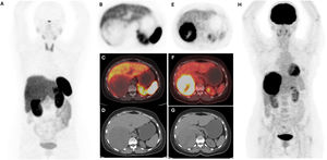 [68Ga]Ga-DOTATATE PET/TC demostró una captación relativamente aumentada del radiotrazador (SUVmáx 4) en la masa suprarrenal (figs. 2A-D). La PET/TC con [18F]FDG mostró un aumento heterogéneo intenso de la captación del radiotrazador en la masa suprarrenal (SUVmáx 12,03) (figs. 2E-H). No se observó captación anormal del trazador en otras áreas corporales.