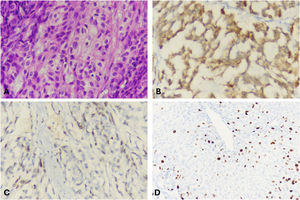 Células neoplásicas con citoplasma claro y eosinófilo, algunas de ellas con pequeños nucleolos, tienen núcleos redondos a ovalados (Hematoxilina & eosina ×40) (fig. 3A). Las células neoplásicas mostraron variación en el tamaño nuclear. Se han descrito tinciones nucleares y citoplasmáticas focales positivas para la calretinina (fig. 3B) y tinciones nucleares focales positivas para el factor esteroidogénico-1 (fig. 3C). El índice de proliferación Ki-67 fue deL 5-10% (fig. 3D).
