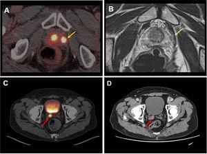 Ejemplo de la extensión extracapsular e invasión de las vesículas seminales en 2 pacientes con cPr. Extensión extracapsular visible en las imágenes de fusión PET/TC con PSMA (A: flecha amarilla) y en la resonancia nuclear magnética (B: flecha amarilla). C) Imagen axial de fusión PET/TC con PSMA donde se identifica un depósito patológico en la vesícula seminal derecha con correlato morfológico en la imagen TC (D: flecha roja).