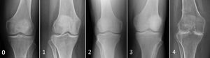 Grado de cambios osteodegenerativos según la escala Kellgren-Lawrence: 0, ausentes; 1, dudosos; 2, leves; 3, moderados; 4, avanzados