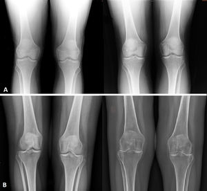 A) Paciente con estabilidad radiológica con grado Kellgren-Lawrence 1 en 2años de evolución, con imagen de la izquierda previa a la radiosinovectomía y en la derecha posterior a la misma. B) Paciente con progresión radiológica con grado Kellgren-Lawrence de 1 (imagen de la izquierda previa a la radiosinovectomía) a 4 (imagen de la derecha posterior a la radiosinovectomía) en 2años de evolución.