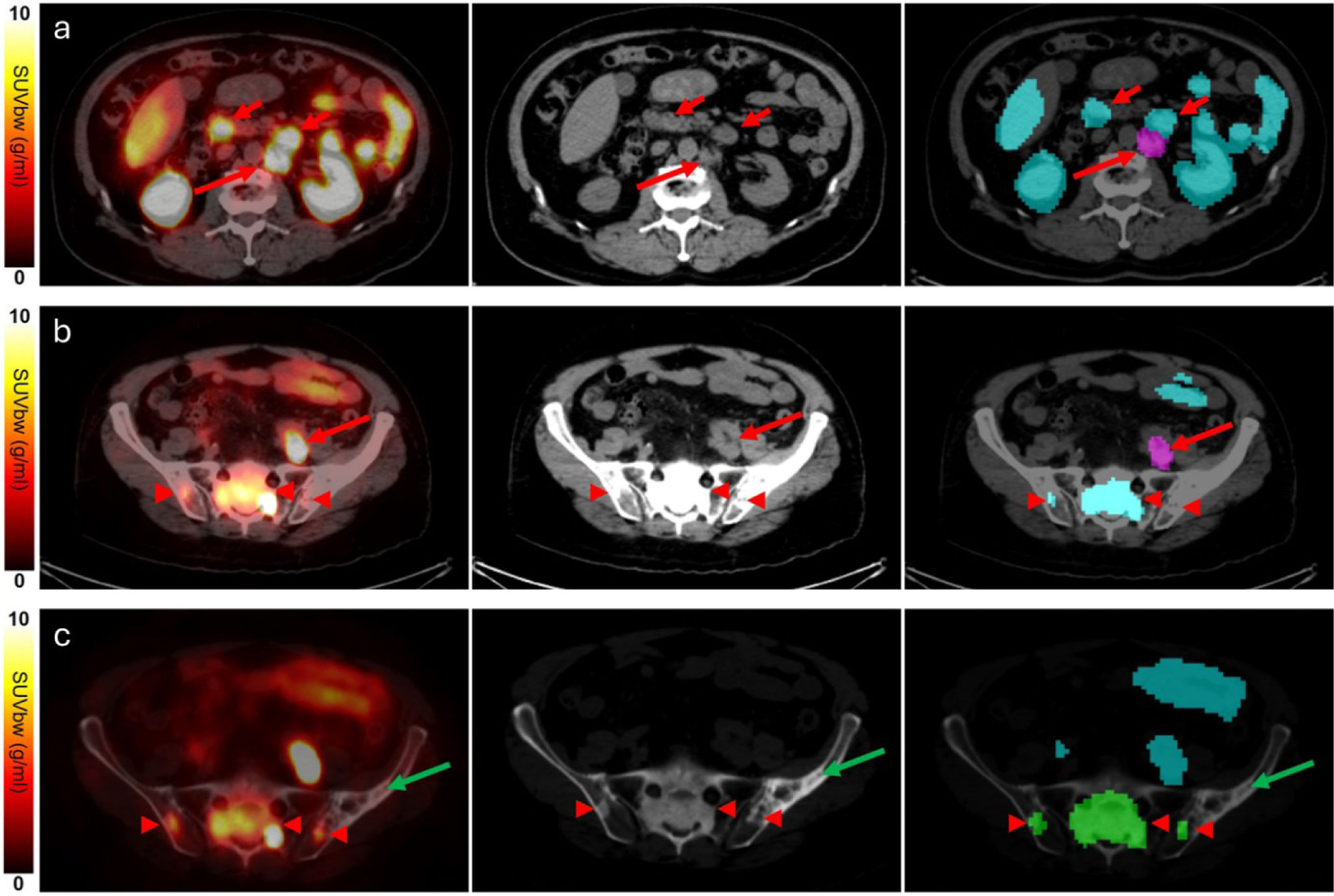 Valor predictivo de los patrones de distribución metastásica en la PET ...
