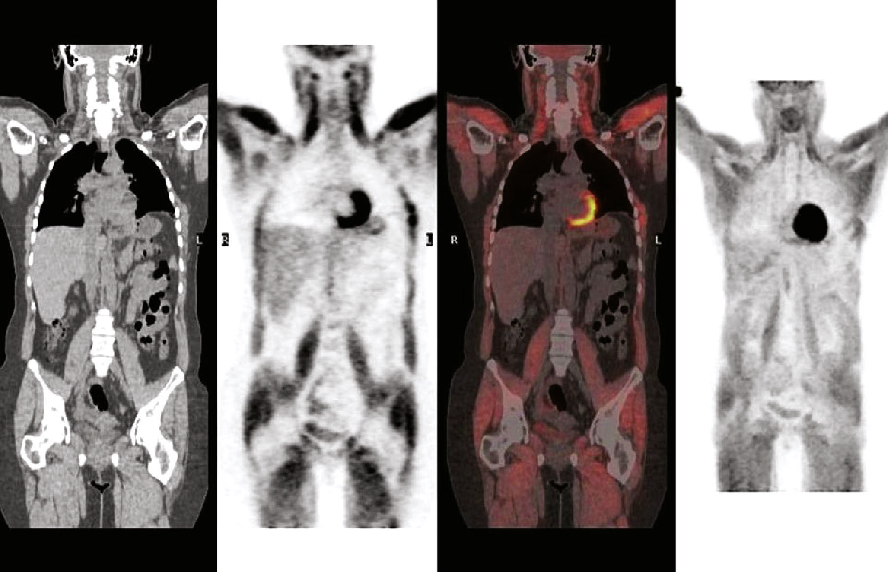 Normal blood glucose level and 18F-FDG PET/CT | Revista Española de ...