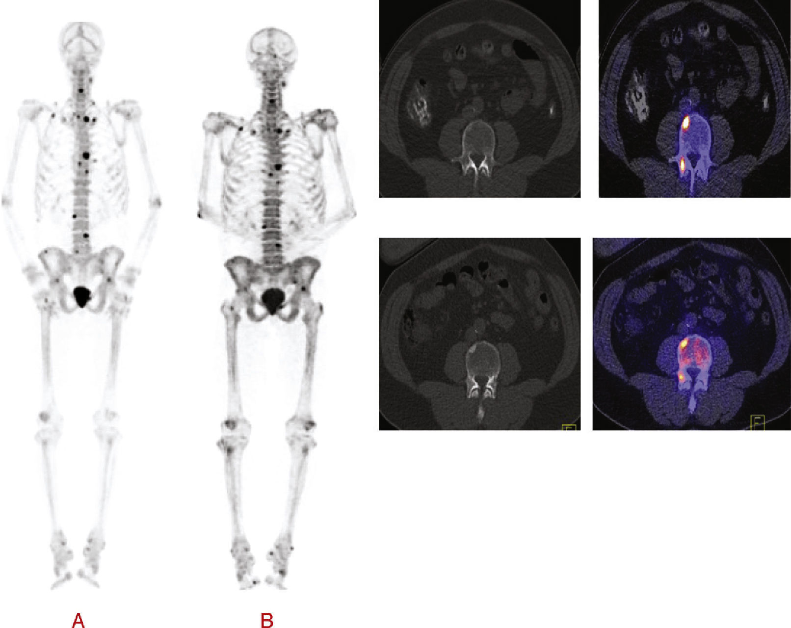 Multimodality imaging in biochemical recurrence of prostate cancer ...