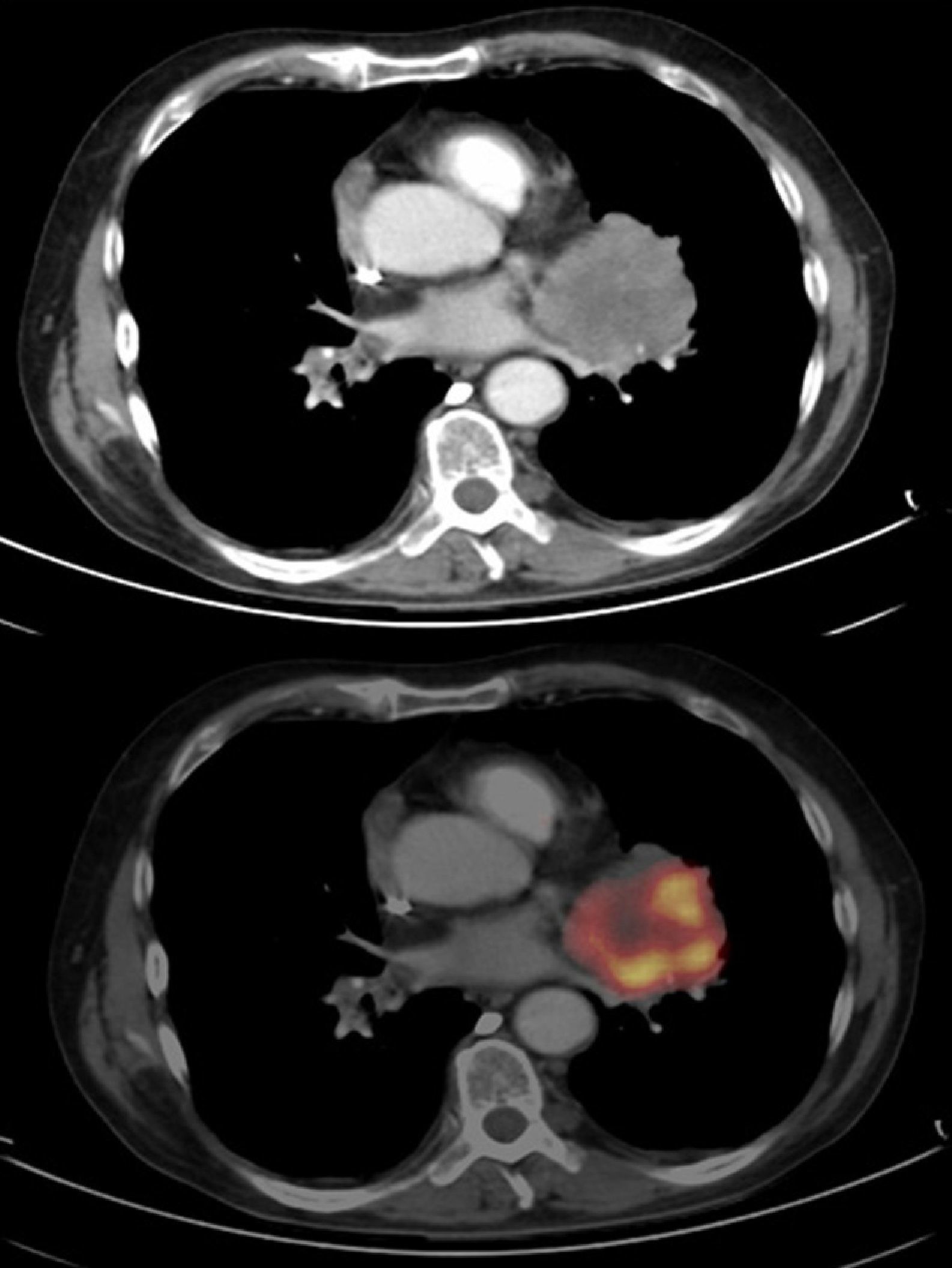Detection of pulmonary tumour thrombosis by integrated 18F-FDG PET/CT ...