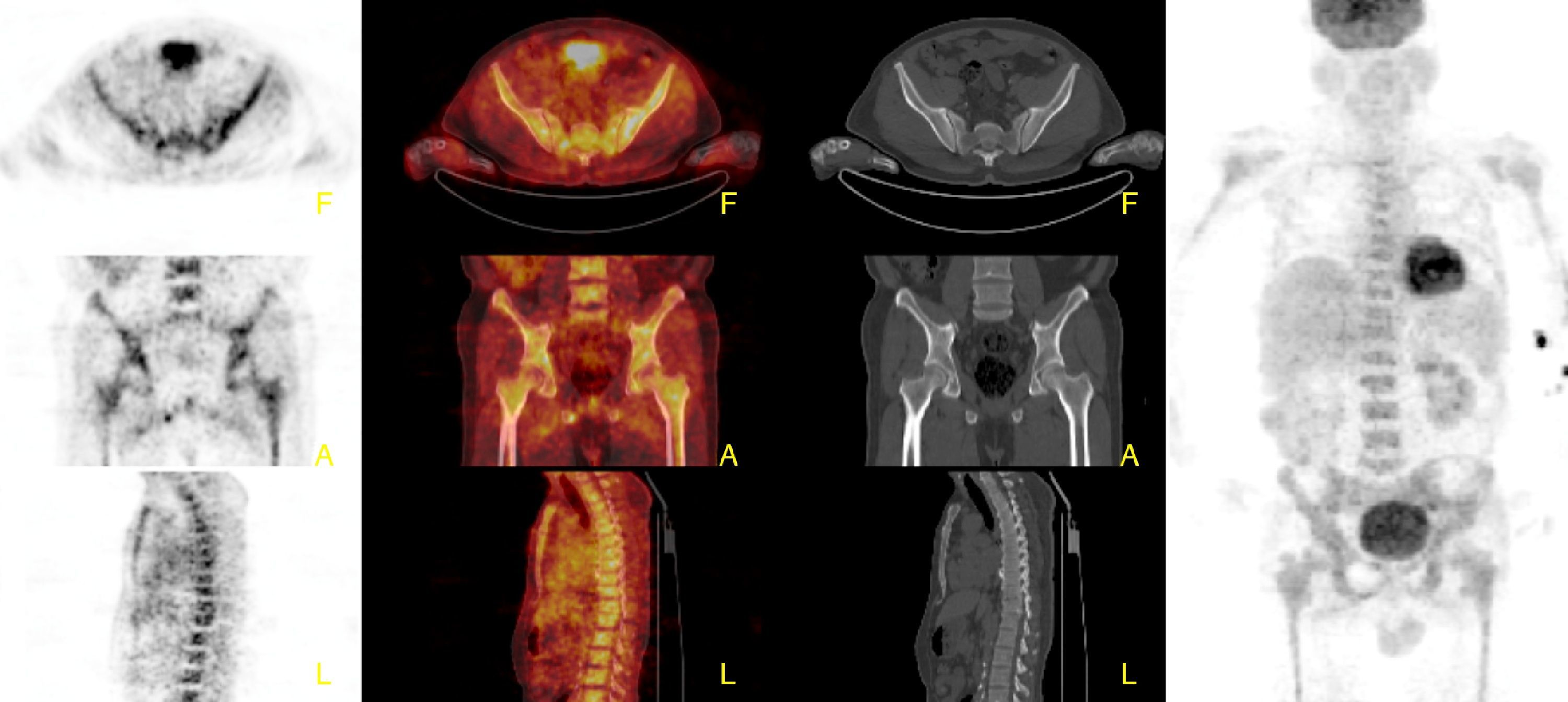 Chronic myeloid leukemia detected on FDG PET/CT imaging in a patient ...
