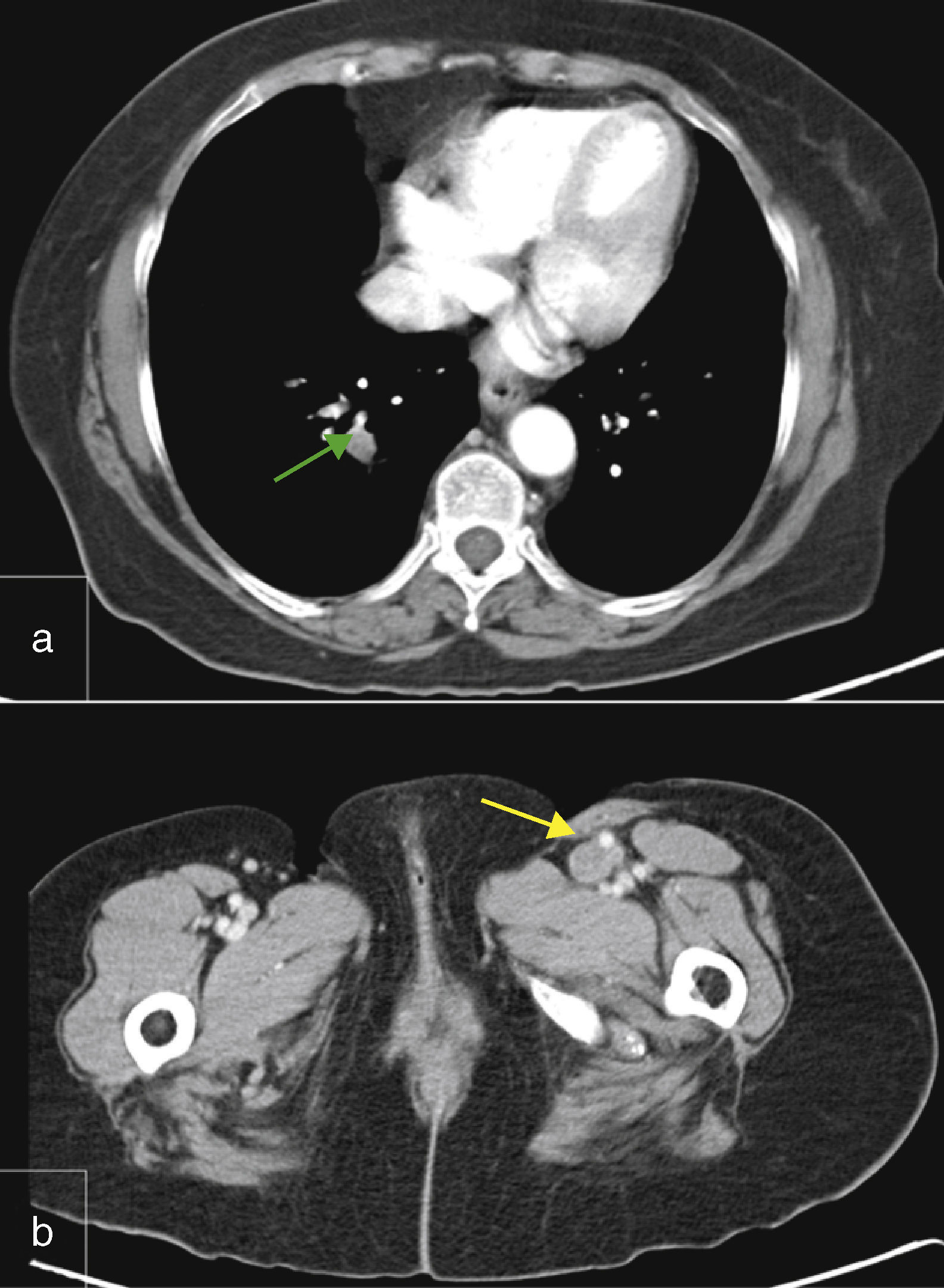 Tumor thrombosis detected on PET/CT scanning in a patient with ...