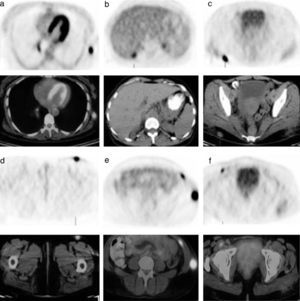 Posttreatment FDG-PET/CT revealed increased FDG uptake (SUVmax: 19.8) subcutaneous tissue in left lower lateral chest (a), hepatorenal area (b), right gluteal area (c), left upper anterior region of the thigh (d), left lower quadrant of abdominal wall and the left abdominal oblique muscle (e), and right iliopsoas muscle (f).