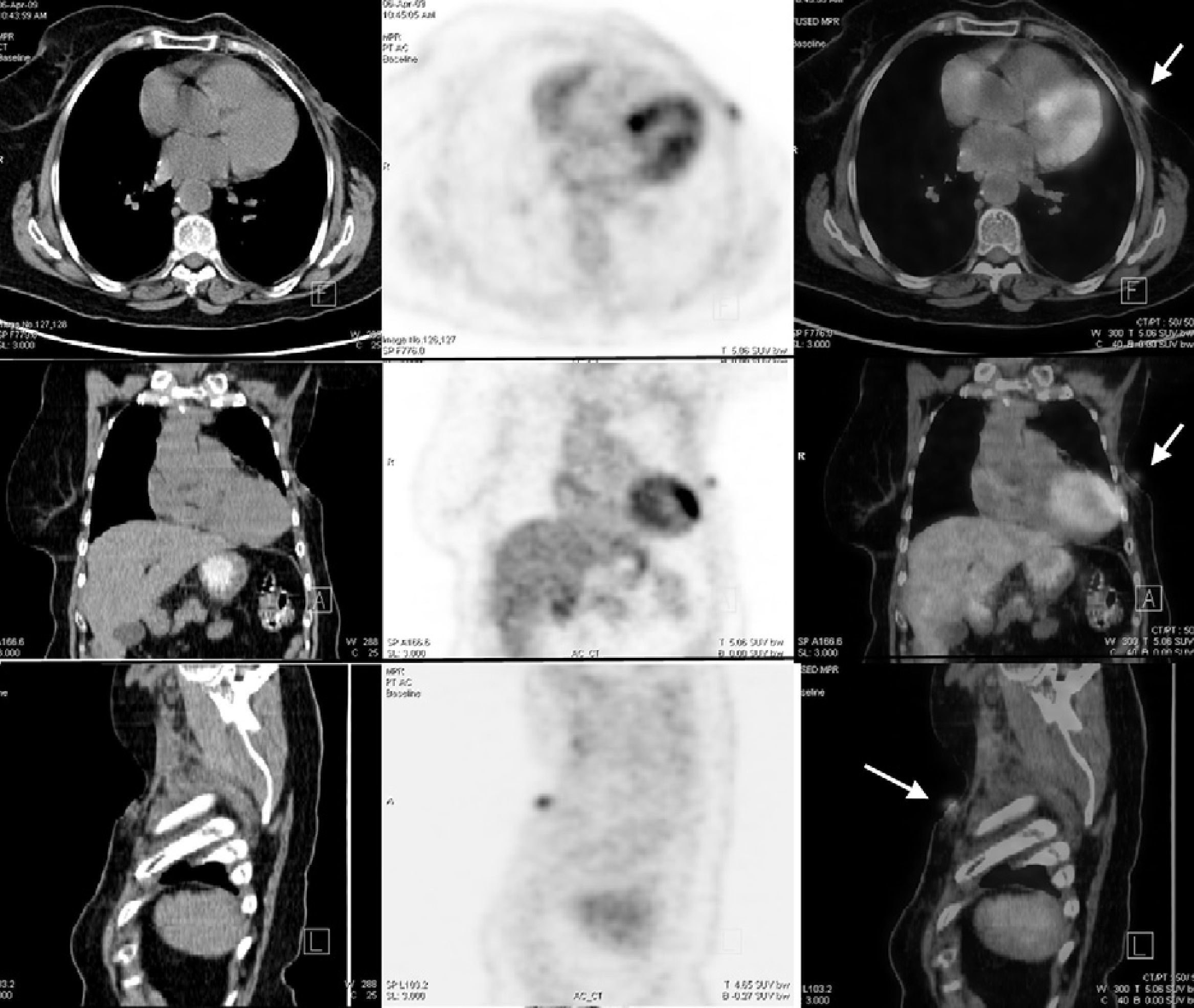 Fat necrosis may mimic local recurrence of breast cancer in FDG PET/CT ...