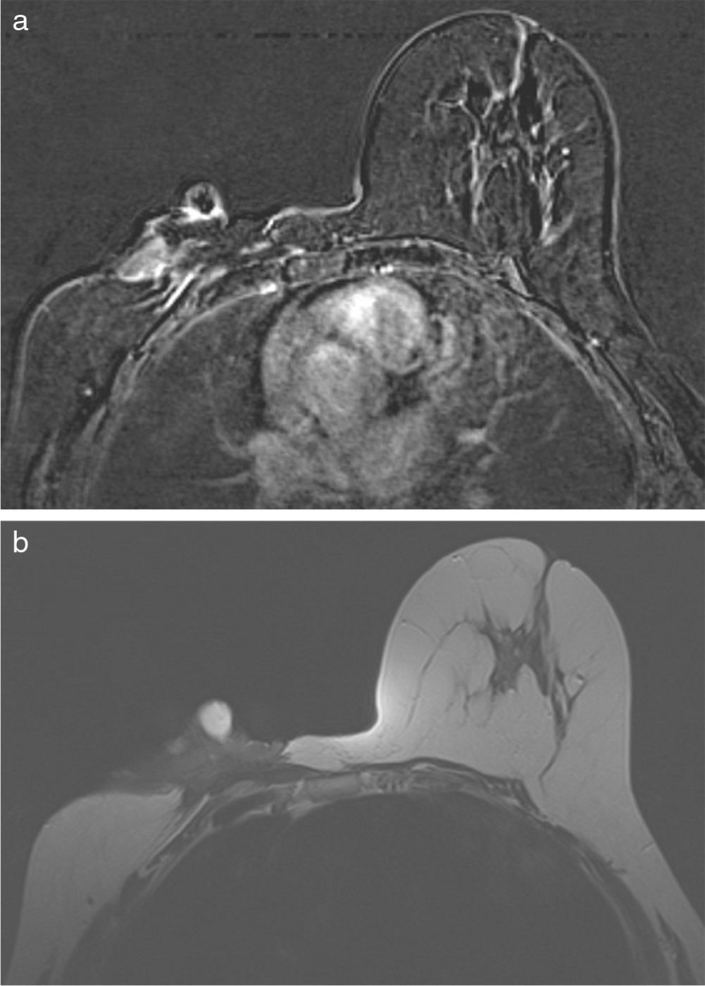 Autoamputation of breast caused by invasive ductal carcinoma | Revista ...