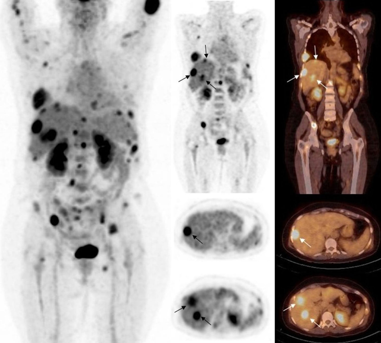 Evolution of solitary plasmacytoma of the sternum to multiple myeloma ...