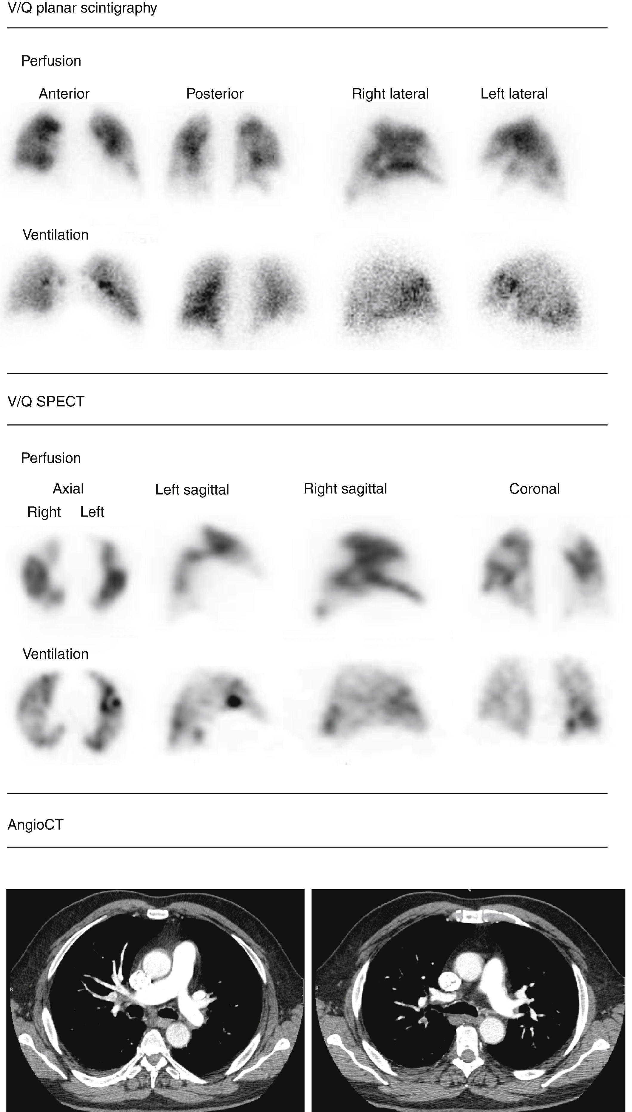Contribution of V/Q SPECT to planar scintigraphy in the diagnosis of ...