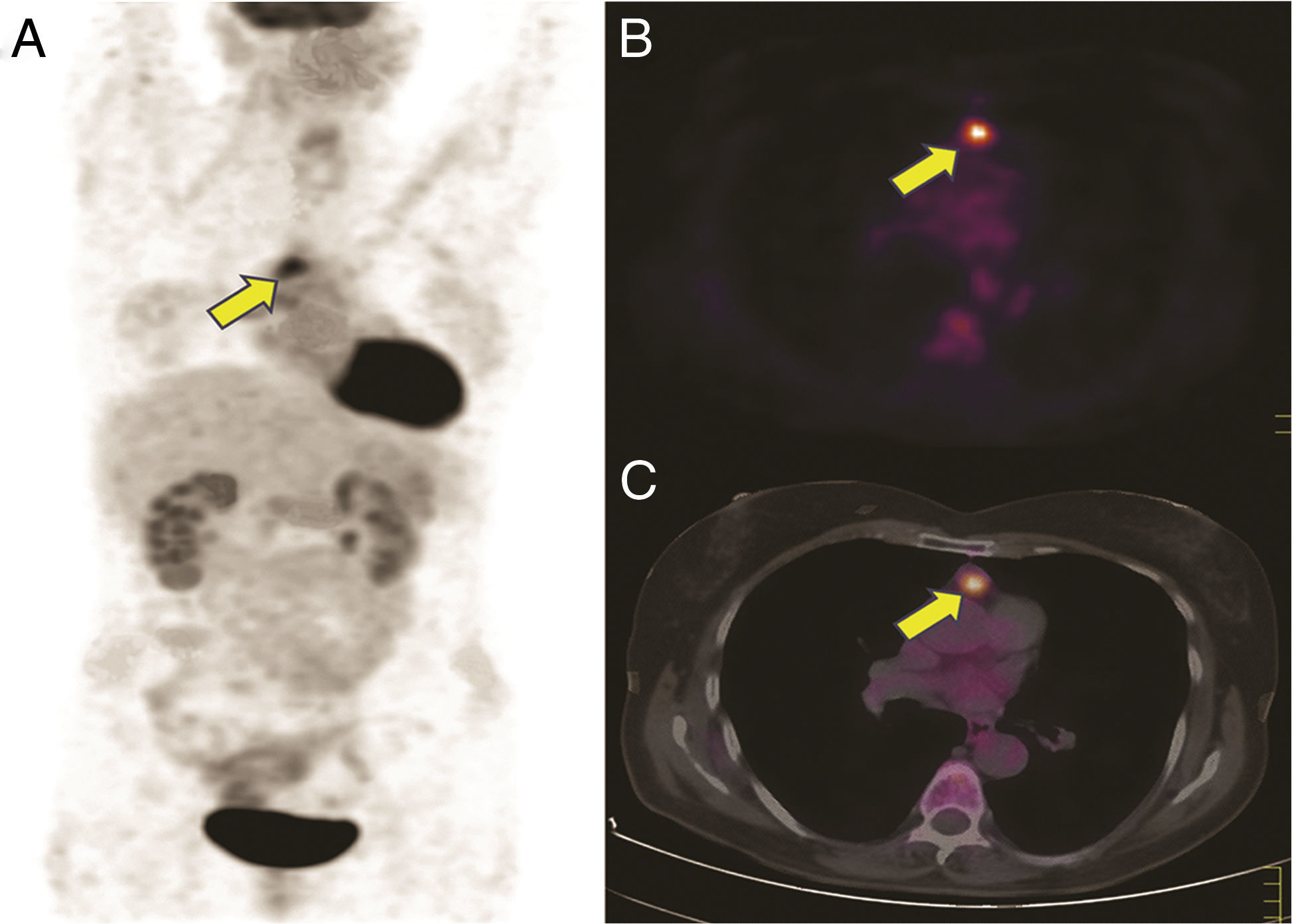 An unusual case of thymic carcinoid causing Cushing's syndrome due to ...