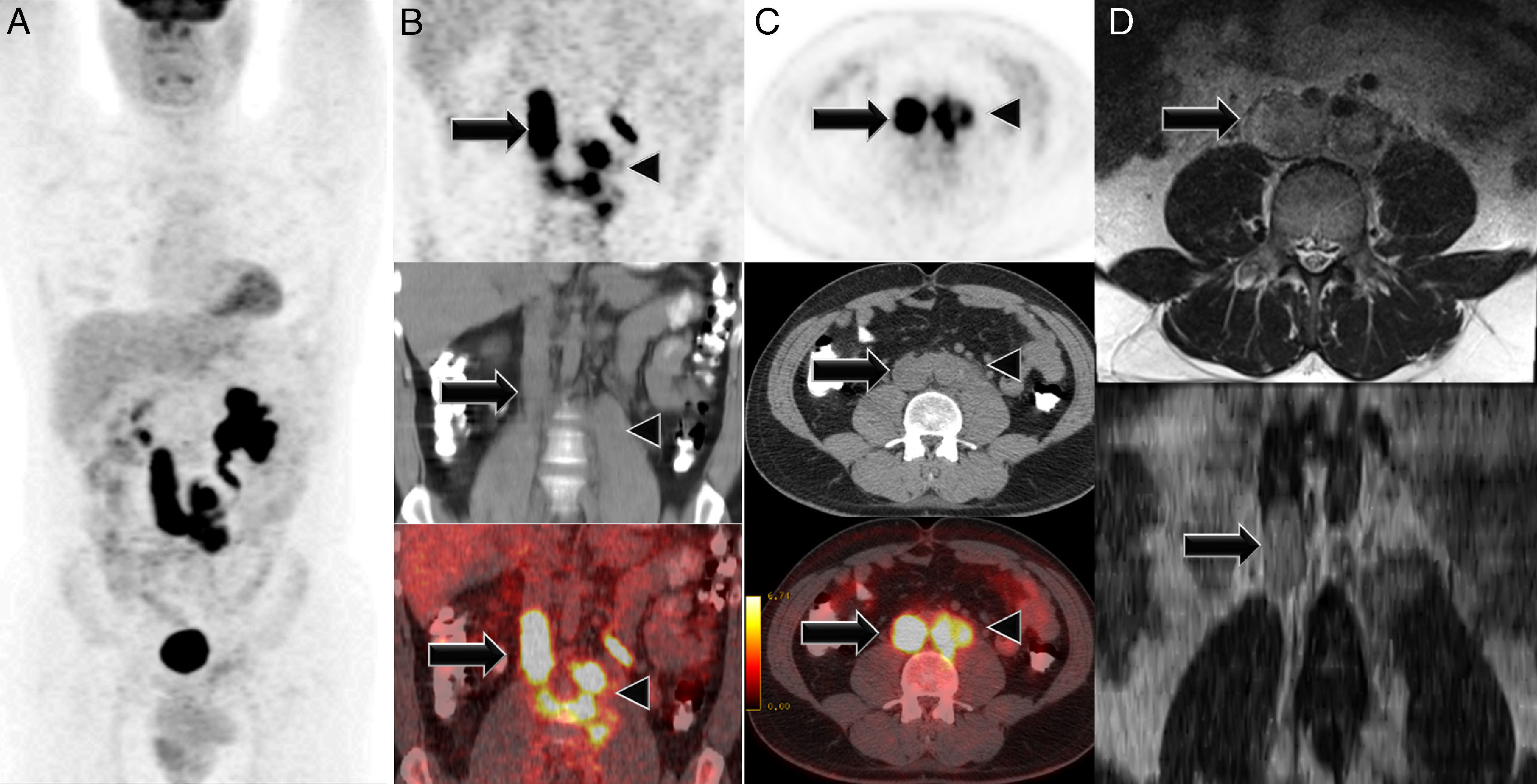Caval Seminoma Thrombus on FDG PET/CT | Revista Española de Medicina ...