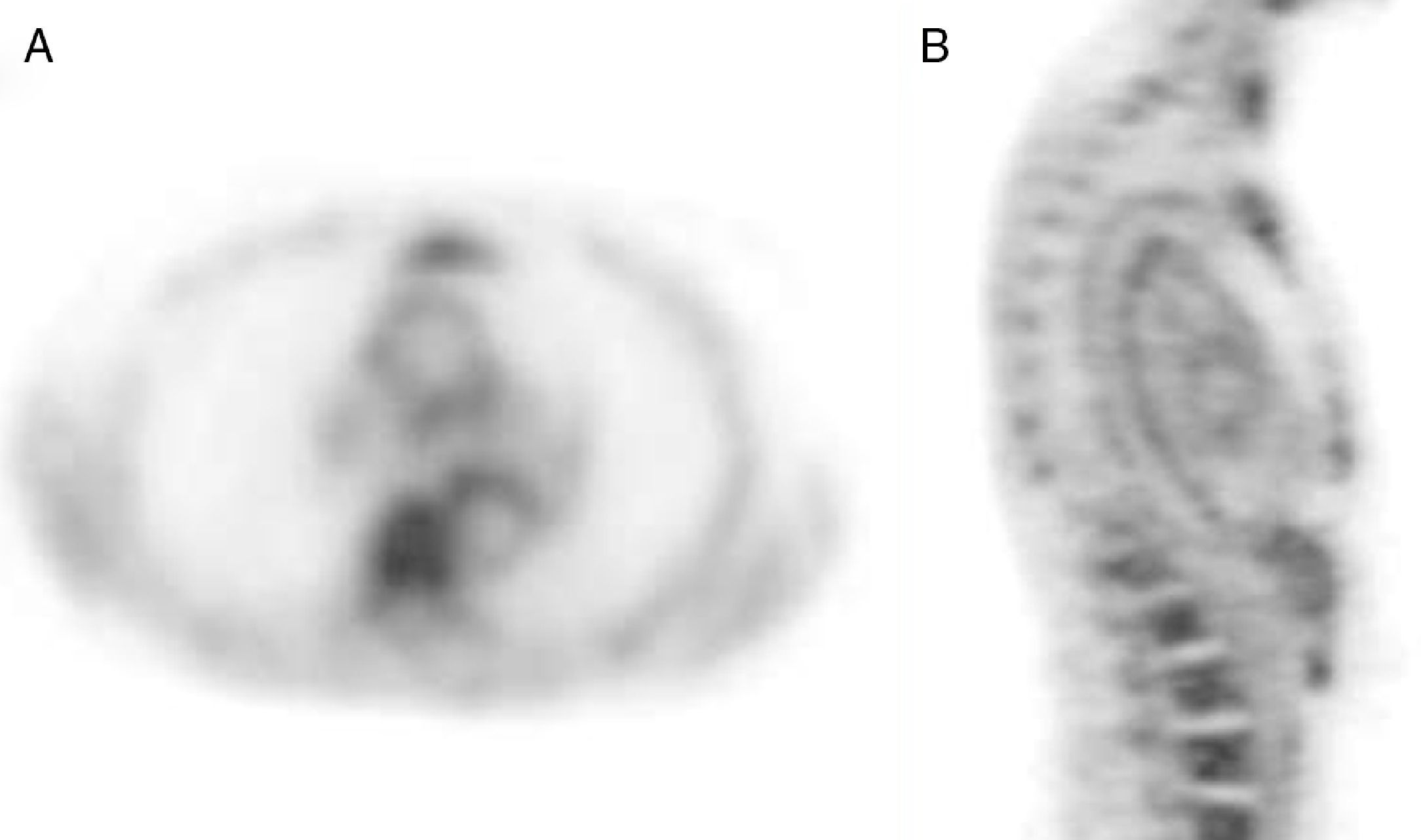 18F-FDG PET/CT for the detection of large vessel vasculitis in patients ...