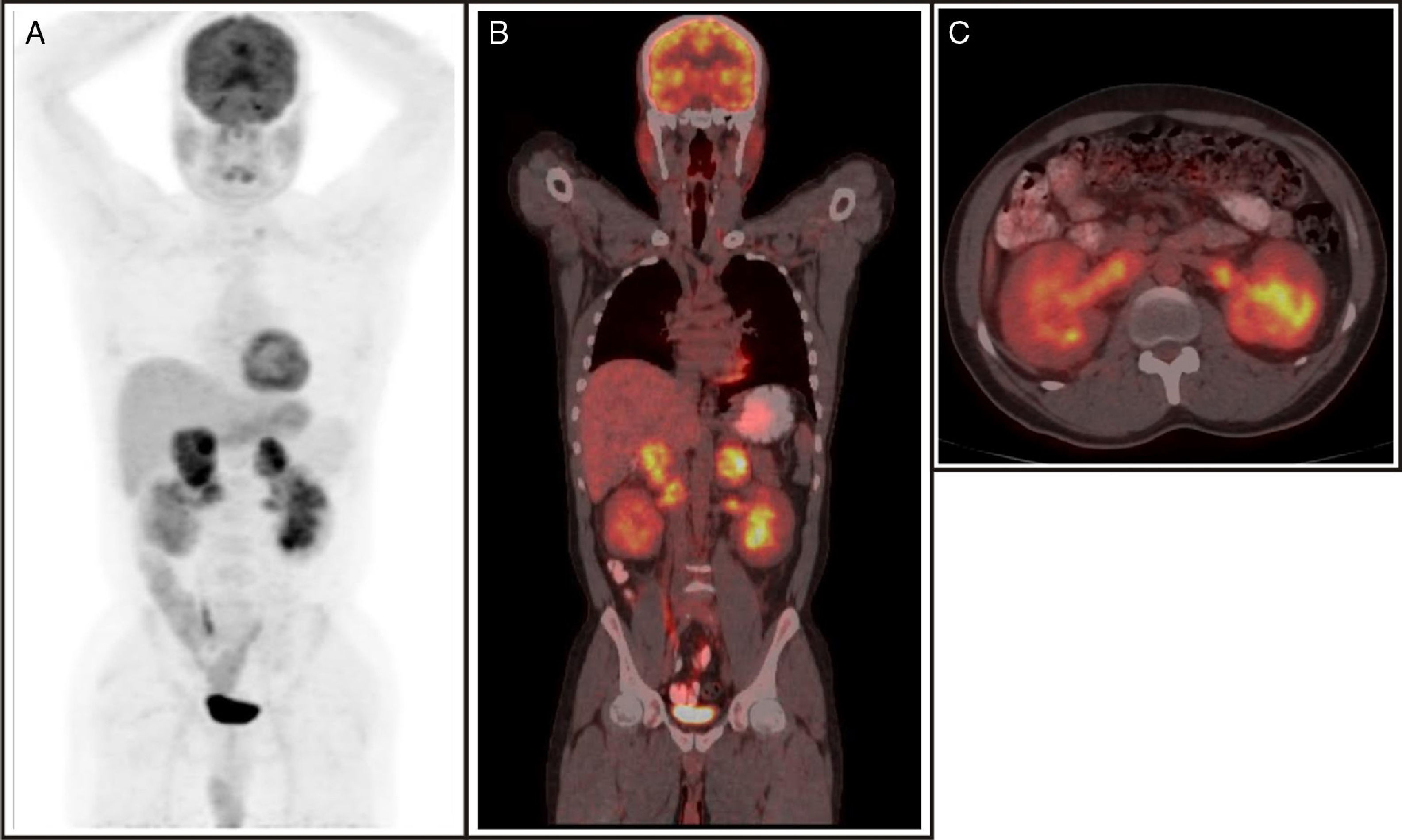 Incidental diagnosis of tumor thrombosis on FDG PET/CT imaging ...
