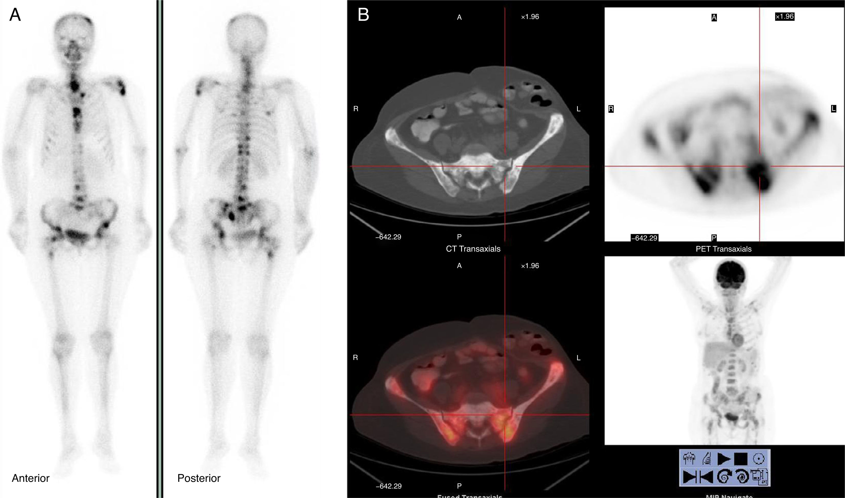Detection of bone metastases in breast cancer patients in the PET/CT ...