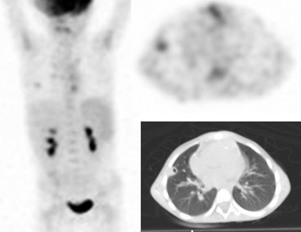 Diagnosis by 18F-FDG PET/CT of infective endocarditis, staging and ...
