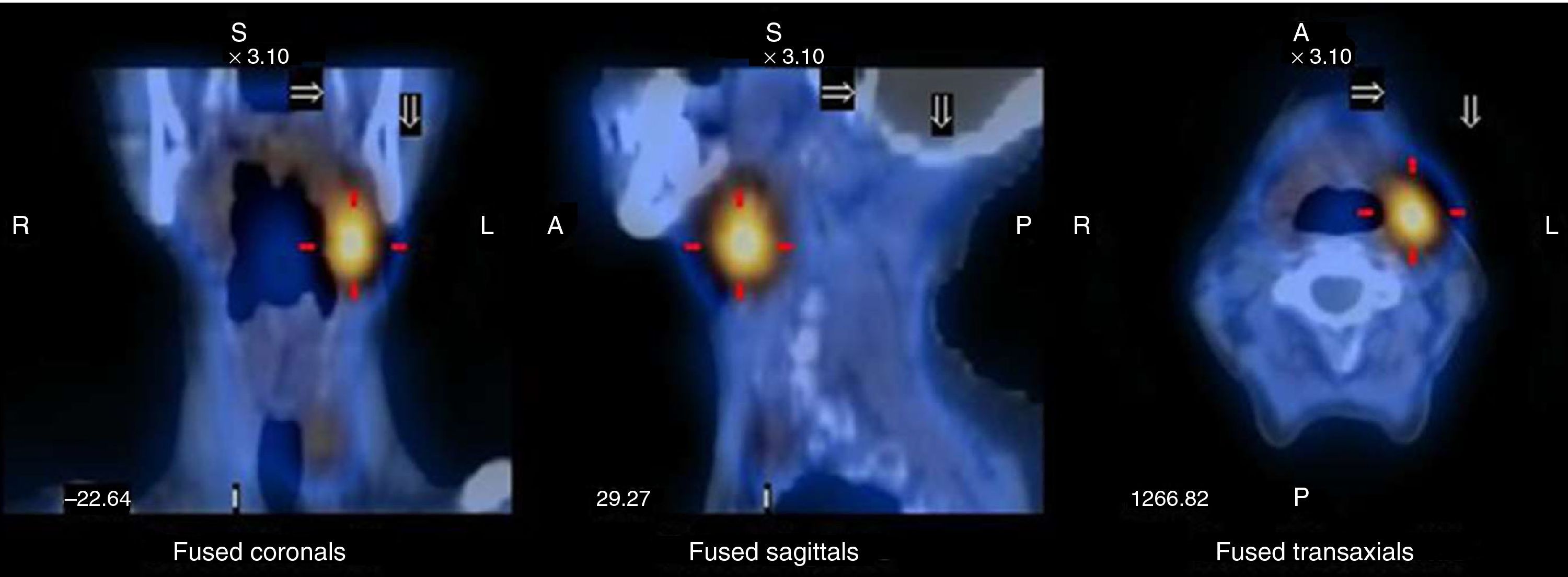 A rare case of double parathyroid adenoma evidenced by 99mTc-sestaMIBI ...