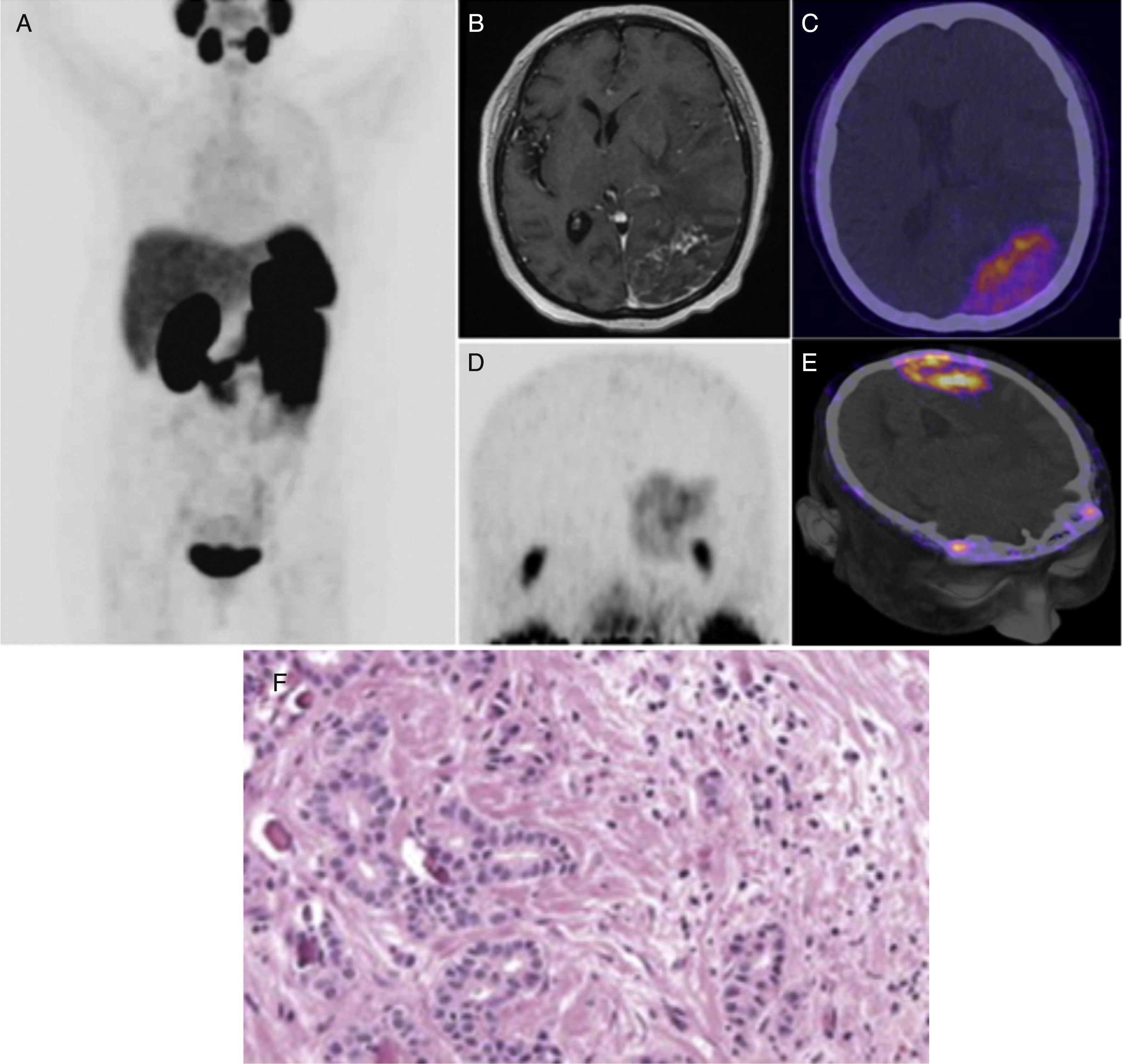 A single brain metastasis seen on 68Ga-PSMA PET/CT in recurrent of ...