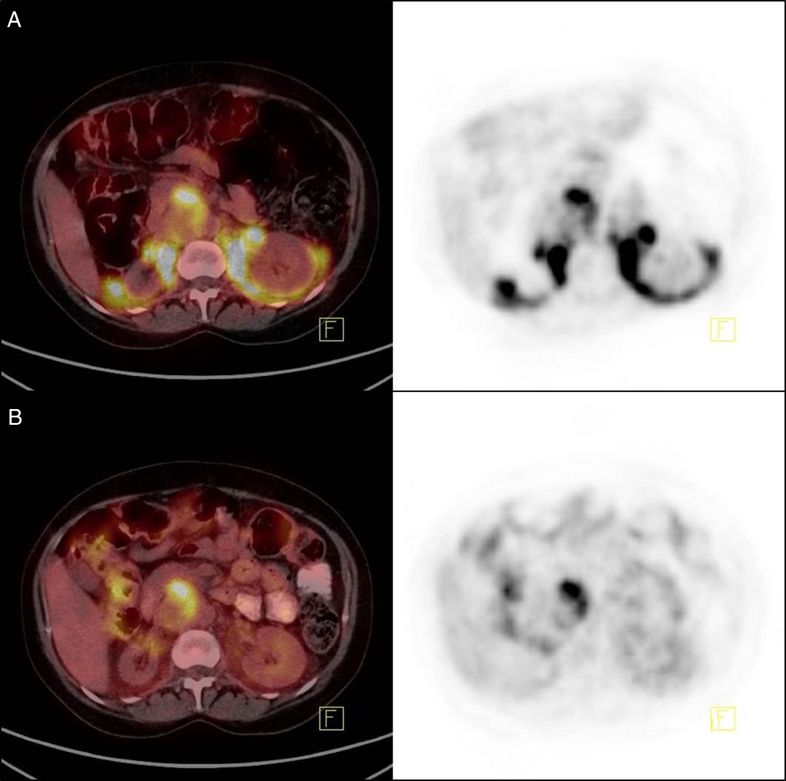 18F-FDG PET/CT findings in a patient with paraganglioma: Brown adipose ...