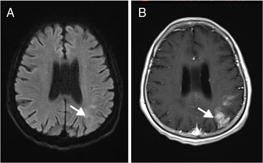 Subacute cerebral infarction incidentally detected by 99mTc-MDP bone ...
