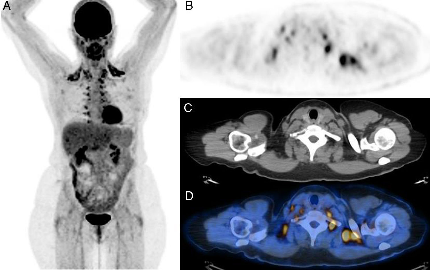 18F-FDG PET/CT brown fat detection: Differences between adult and ...
