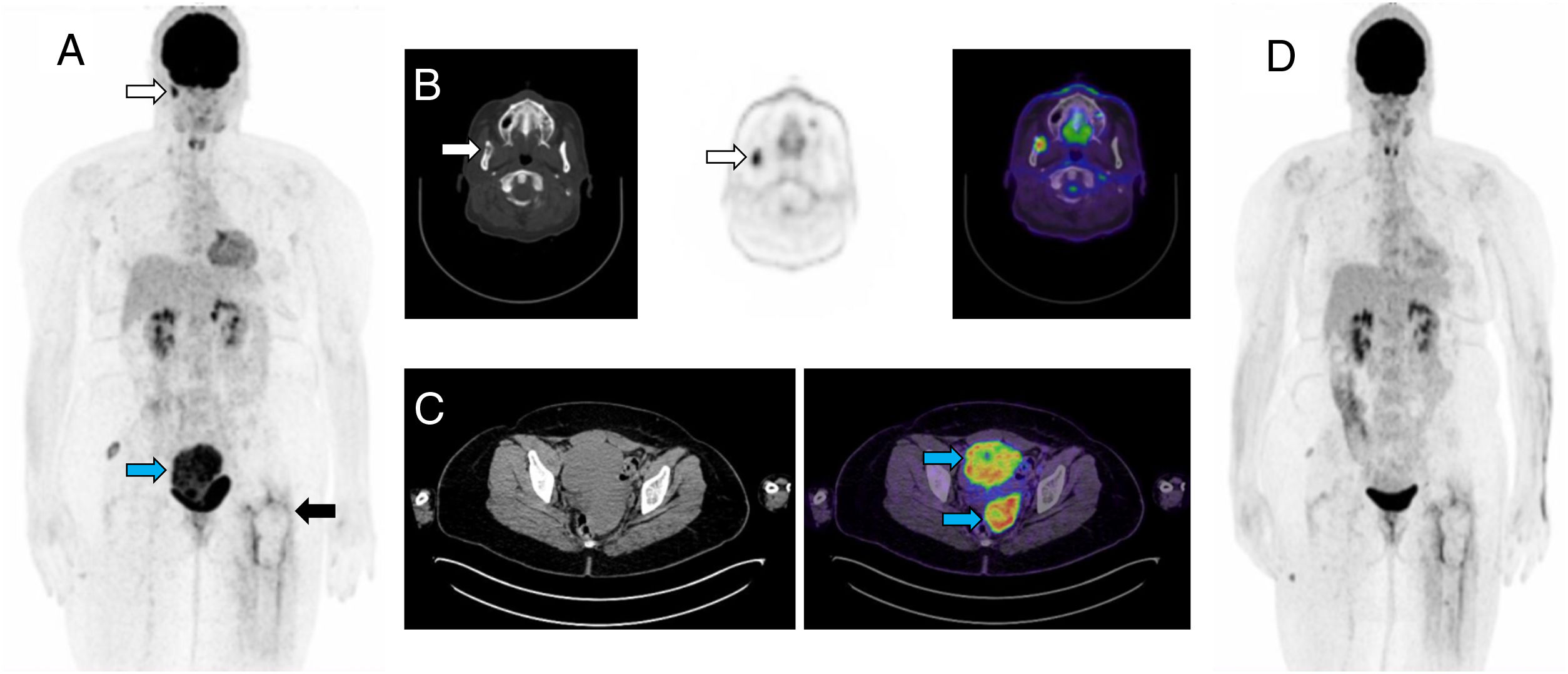 Bilateral ovarian plasmacytoma detected on 18F-FDG PET/CT | Revista ...