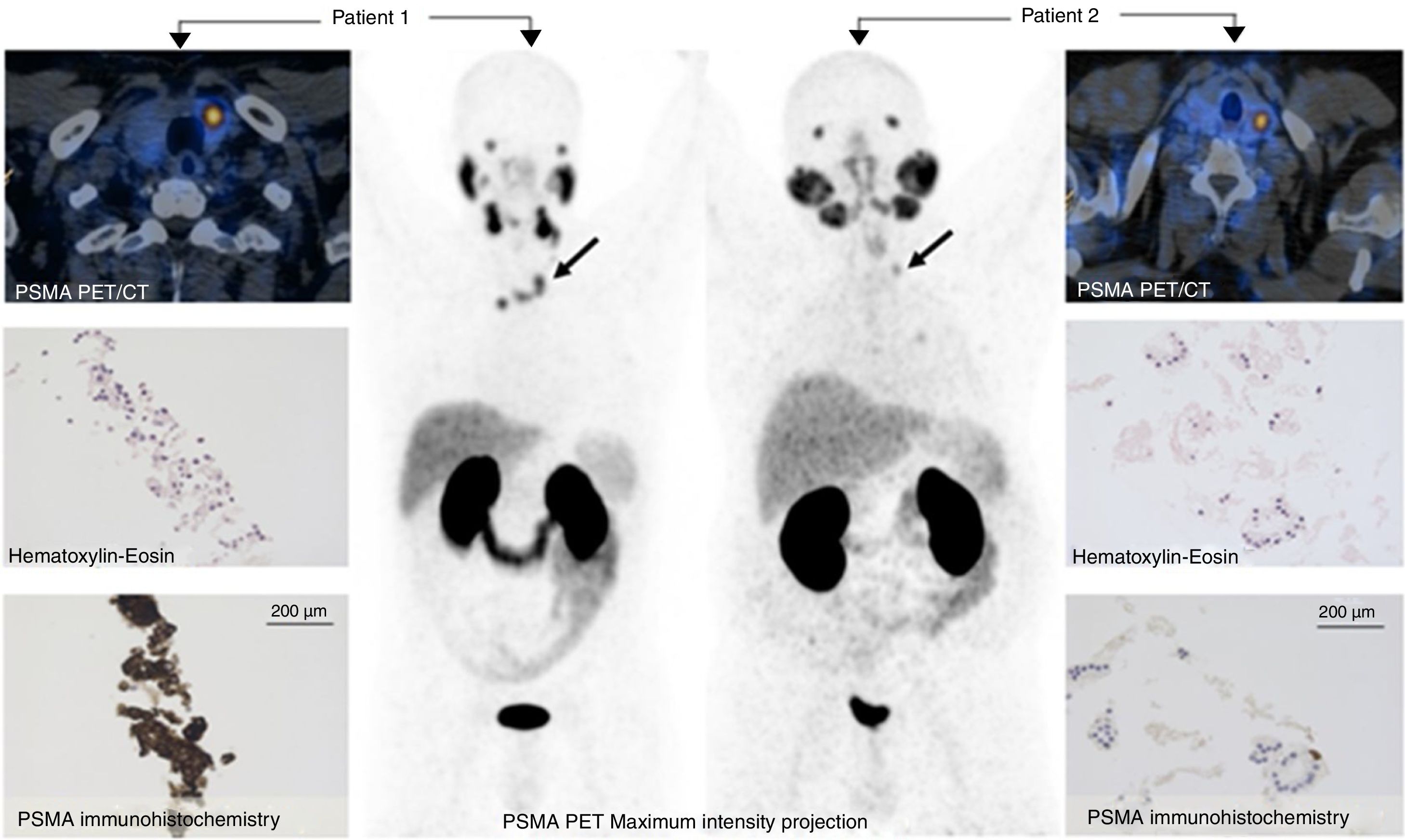 PSMA expression in thyroid nodule | Revista Española de Medicina ...