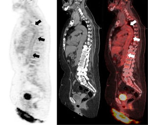 Sagittal views of PET (left), CT (center) and PET/CT image fusion (right) showing an increased glucose metabolism along the aortic wall suggesting a large vessel vasculitis (arrows). Maximumstandardized uptake value (SUVmax) of the aortic wall: 4,91; SUVmax of the liver: 4,52.