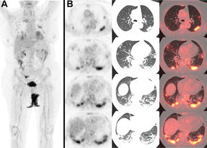 A) Maximum intensity projection showing hypermetabolic foci in both lungs. B) Axial views of PET images (left), CT (center), and PET/CT image fusion (right) showing bilateral multifocal lung lesions with ground glass opacifications, especially in the lower lobes, with some consolidation areas in the posteriorbasal segments, and increased glucose metabolism (SUVmax left lower lobe 11,69), consistent withbronchopneumonia.