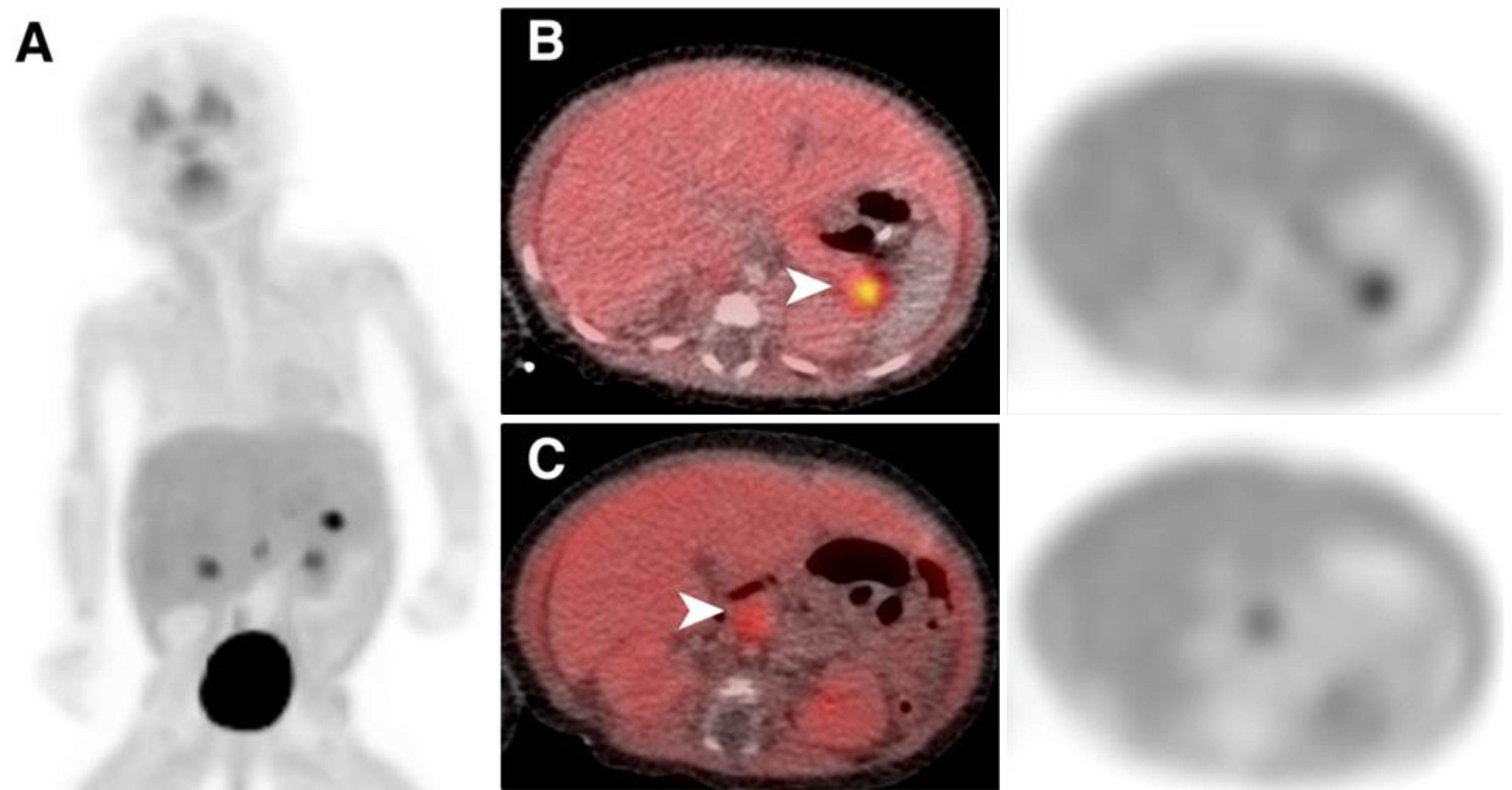 Focal form of congenital hyperinsulinism in a newborn diagnosed with ...