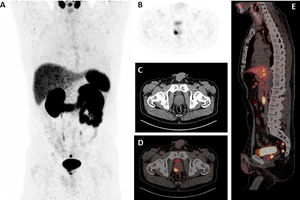 50-year-old patient with prostate adenocarcinoma Gleason 3 + 4 (ISUP grade 2) with an initial PSA of 12 ng/mL and a normal CT and BS. Initial staging with [68Ga]Ga-PSMA-11 PET/CT was performed prior to radiotherapy treatment. PET/CT images with [68.Ga]Ga-PSMA-11 (A: MIP, B: PET, B: CT, C: Axial fusion PET/CT and E: Sagittal fusion PET/CT) showed two foci with elevated PSMA receptor expression in the right prostate lobe and two presacral adenopathies compatible with tumoral infiltration.