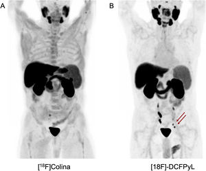 Comparison of maximum intensity projections (MIP) of [18F]F-Choline and [18F]F-DCFPyl in a patient with prostate cancer treated with radical prostatectomy presenting progressive elevation of PSA levels (2.13 ng/mL) and suspicion of biochemical recurrence. The study with [18F]F-Choline (A) did not detect the localization of recurrence. However, the study with [18F]F-DCFPyl (B) localized the site of recurrence as two hypermetabolic foci in the left internal iliac chain corresponding to lymph node infiltration. The deposits visualized on the right correspond to physiological ureteral retention of the radiopharmaceutical.