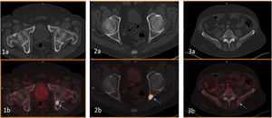 PET/CT study with [68Ga]Ga-PSMA-11 in a patient with a history of Gleason 6 (3 + 3) prostate cancer treated with brachytherapy 10 years previously and current biochemical progression despite hormone treatment. Although the conventional imaging studies (CT and BS) were negative, PET-PSMA detected tumoral disease in the left acetabulum (blue arrow in 1b), left ischium (blue arrow in 2b) and left iliac crest (blue arrow in 3b) not visible in the radiological CT image of PET/CT (1a, 2a and 3a). The lesions were treated with stereotactic radiotherapy with PSA response at 8 months.