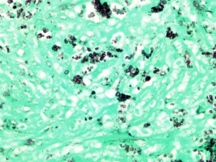 Histoplasmosis in the differential diagnosis of hypermetabolic adrenal ...
