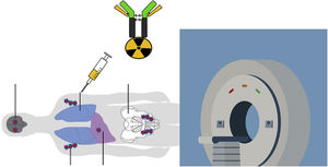 Scheme showing the injection of an immunoPET probe made up of an antibody labeled with a radioactive isotope which will serve to make the PET image. Designed by macrovector/Freepik.