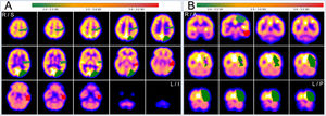 Axial (A) and coronal (B) quantitative PET assessment (SPM) by neurocloud.es software quantification platform, using AAL atlas (z-score). Red areas indicate a more extended hypometabolic asymmetry than hypometabolism observed on the visual evaluation in the left anterior temporal lobe (with 3 SD). R = right, L = left, S = superior, I = inferior.