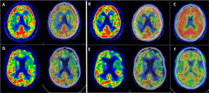 Example of FMFs, its corresponding [18F]FDG PET image, as well as amyloid PET. Top row: 52-year-old female with suspected lvPPA. (A) Axial slices of [18F]FDG PET and fusion with CT, showing asymmetric right parieto-temporal hypometabolism. (B) Axial slices of early first-minute [18F]FMM PET (FMF) and fusion with CT, showing asymmetric right parieto-temporal hypoperfusion with a distribution similar to the corresponding [18F]FDG PET scan. (C) Axial slice of late-phase [18F]FMM PET scan, positive for pathological amyloid deposits in the cerebral cortex. The findings support the diagnosis of lvPPA as a presentation of AD with biomarker support. Bottom row: 65-year-old male with focal onset mild to moderate cognitive impairment of the PPA type. (D) Axial slices of [18F]FDG PET and fusion with CT, showing predominantly left frontal and temporal lobar hypometabolism. (E) Axial slices of early first-minute [18F]FMM PET (FMF) and fusion with CT, showing frontal and temporal hypoperfusion of similar distribution to the [18F]FDG PET scan. (F) Axial slice of late-phase [18F]FMM PET scan, negative for pathological amyloid deposits in the cerebral cortex. The findings support a diagnosis of nfvPPA in the context of FTD with biomarker support.