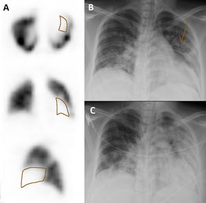 Axial, coronal and sagittal slices of the scintigraphy performed in patient 3 showing an uptake defect in the low segment of the lingula (A, brown) attributable to an area of pneumonia (B, arrow), with radiological progression over the following three days (C).
