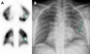 Axial and coronal slices of the pulmonary perfusion scintigraphy performed in patient 4 showing a defect of sub-segmentary size in the upper lower left lobe (A, green) coinciding with radiological infiltrate (B, arrow).