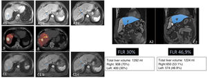 69-year-old patient with binodular hepatocarcinoma, with no distant disease and preserved liver function. Two lesions can be seen in the MR in segments VII and VIII (A). Images A1b and A1c show that the lesion of segment VIII is in contact with the right suprahepatic vein. This, together with the fact that the liver remnant after right hepatectomy would be 30% (A2), led to considering the performance of RE with the double objective of downstaging and hypertrophy of the liver remnant. In the 90Y PET study (B), after the administration of 1.5GBq of 90Y resin microspheres into the hepatic artery, adequate arrival of the treatment to the tumoral lesions (mean dose absorbed of 185Gy) and to the right non-tumoral liver tissue (mean dose absorbed of 76Gy; V30 56%) was observed. Five months after RE the separation of the VIII lesion from the adjacent vein (C1) was checked (C1b and C1c) together with adequate hypertrophy of the remnant (C2). The patient underwent laparoscopic right hepatectomy (not requiring transfusion; 3 days of hospitalization). At the last check-up (72 months after surgery) the patient remained alive and disease-free.