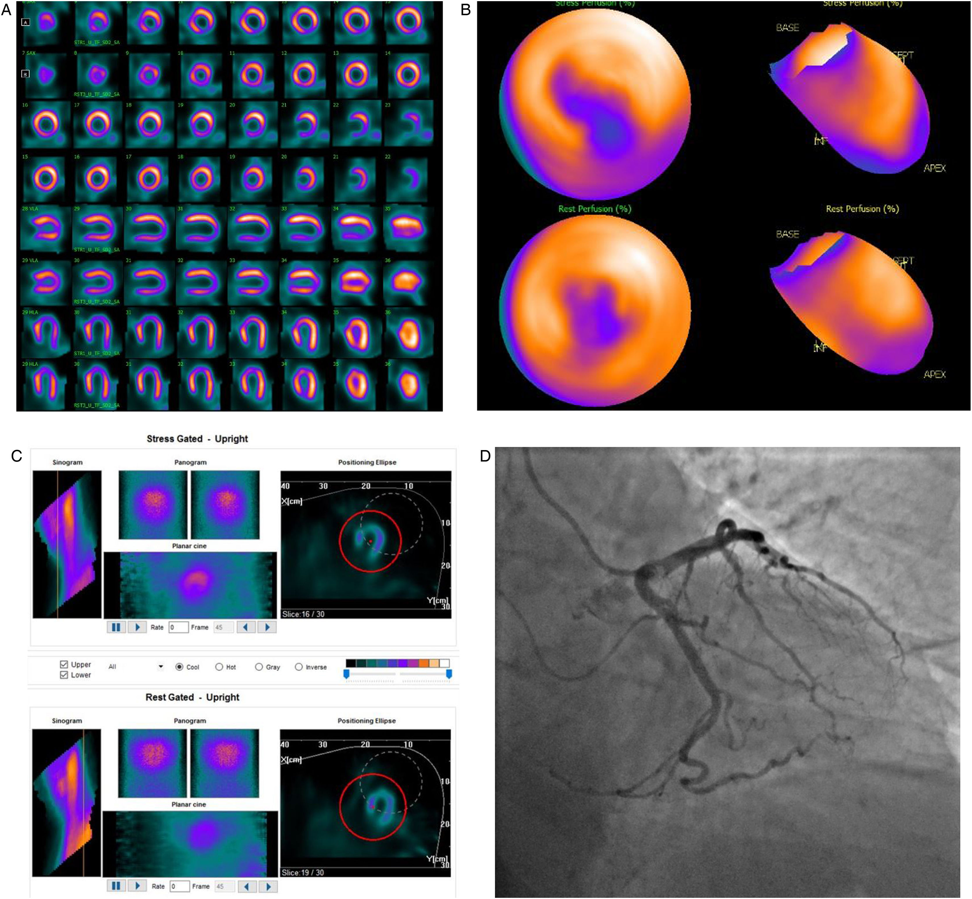 Diagnostic performance of different cardiac stress protocols for ...