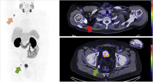 PET/CT performed after the administration of 220 MBq of 68Ga-PSMA-11 showing high uptake in the right scapula (red arrow) and in a 9 mm lymph node in the perirectal fat (green arrow), suggesting metastases.
