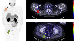 CZT SPECT-CT scan performed after the intravenous administration of 750 MBq 99mTc-MIP-1404 showing high uptake in the right scapula (red arrow) and in a 9 mm lymph node in the perirectal fat (green arrow), suggesting metastases.