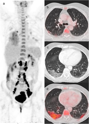 A 60-year-old woman diagnosed with cervical cancer, PET/CT to evaluate lymph node involvement. The maximum intensity projection image (a) shows increased FDG uptake in the cervix and FDG-avid lymph nodes in the left supraclavicular and infradiaphragmatic locations related to her oncologic pathology. FDG uptake is also visualized in lungs and in hilar and subcarinal lymph nodes, related to infectious/inflammatory pathology. Axial and CT images showed a subpleural band in the right upper lobe (b), peripheral crazy paving pattern in the right lower lobe and bilateral GGO (c) with increased 18F-FDG uptake with SUVmax value of 5.5 (d). The rRT-PCR was positive for COVID-19 (CO-RADS 6).