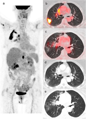 An 85-year-old woman with colon cancer, PET/CT to evaluate treatment response. The maximum intensity projection image (a) demonstrates an FDG-avid abdominal focus related to a retrocrural tumoral lymphadenopathy. Also shows increased FDG uptake in the right lung. Axial fusion (b, c) and CT images (d, e) showed increased FDG uptake (SUVmax 13.2) in the peripheral GGO opacities of the right upper lobe. Axial CT image (e) shows peripheral crazy paving pattern in the right upper lobe. rRT-PCR for COVID-19 was positive (CO-RADS 6).