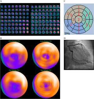 70 year old female, BMI 26, diabetes mellitus type II, smoker, no previous cardiac background known. Apical hypokinesis found during an echocardiography performed as part of a pre-operatory work-up for a recently diagnosed gastric cancer. Referred to MPI to rule out ischemia. MPI evaluation without DLACS (left images). Splash (A) and bulls-eye MPI (B) stress (upper row) and rest (lower row) in the upright position showing a perfusion defect in the infero-septal wall involving even the apex, showing only partial reversibility at rest. Polar map from gated images during stress showing abnormal contractility of moderate degree (C). No significant obstruction of the coronary arteries at ICA (D). MPI evaluation using DLACS (right images) showing no significant perfusion defects. The patient could have avoided ICA.