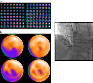 74 year old female, BMI 25, no previous cardiac background known. Pathological electrocardiogram at stress test and angina. Referred to MPI to rule out ischemia. MPI evaluation without DLACS (left images). Splash (A) and bulls-eye (B) MPI stress (upper row) and rest (lower row) in the upright position showing a perfusion defect in the infero-septal wall, corresponding to the right coronary artery territory, showing partial reversibility at rest. Significant obstruction of the right coronary artery confirmed at ICA (C). MPI evaluation using DLACS (right images) showing no significant perfusion defects. False negative result using DLACS.