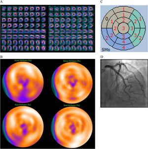 69 year old male, BMI 31, known atrial fibrillation. Pathological ST-T changes in the electrocardiogram at stress test. Referred to MPI to rule out ischemia. MPI evaluation without DLACS (left images). Splash (A) and bulls-eye MPI (B) stress (upper row) and rest (lower row) in the upright position showing a perfusion defect in the infero-apical wall with reversibility of the inferior wall at rest. Polar map from gated images during stress showing abnormal contractility of moderate degree (C). No significant obstruction of the coronary arteries at ICA (D). MPI evaluation using DLACS (right images) showing no significant perfusion defects. The patient could have avoided ICA.